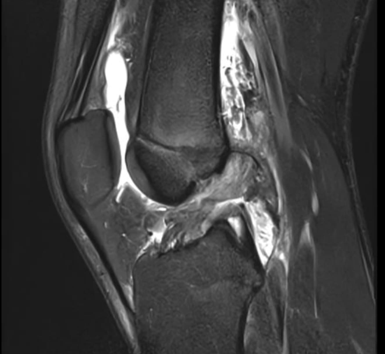 Sagittal MRI of a knee